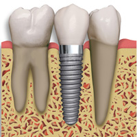 зубной имплантат 