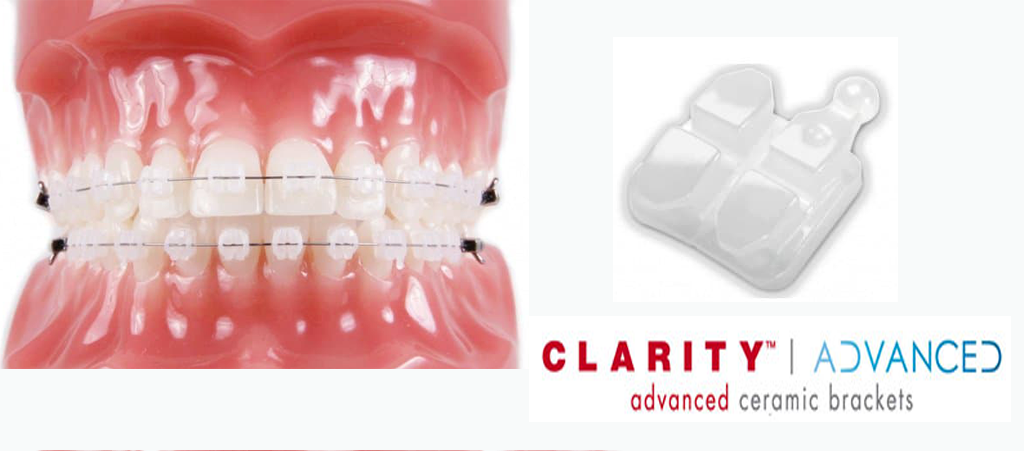 Брекеты Clarity Брекеты Clarity