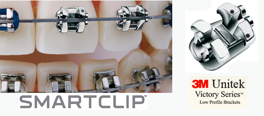 Брекеты Smart clip Брекеты Smart clip