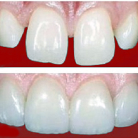 diastema