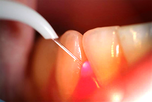 Удаление зубного камня лазером