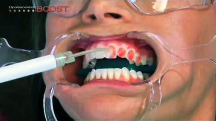 отбеливание зубов Opalescence Boost
