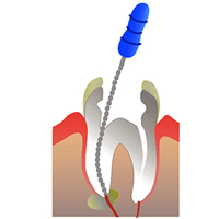 удаление зубного нерва
